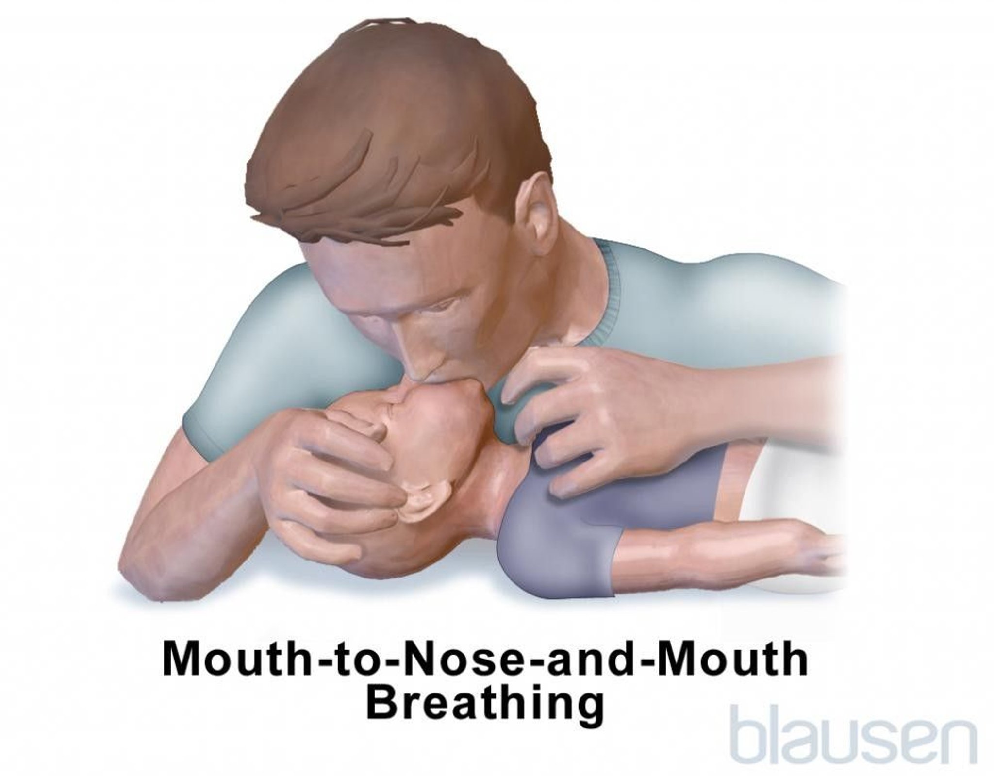 Mouth-to-Nose-and-Mouth Breathing in an Infant