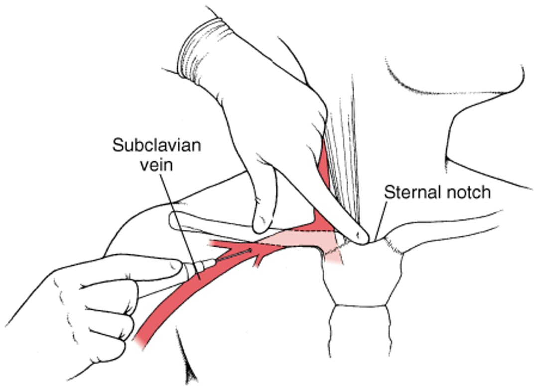 قثطار في أحد أوردة الصدر