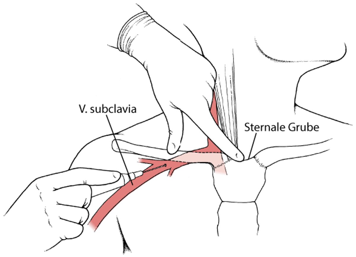 Katheter in einer Vene im Brustkorb