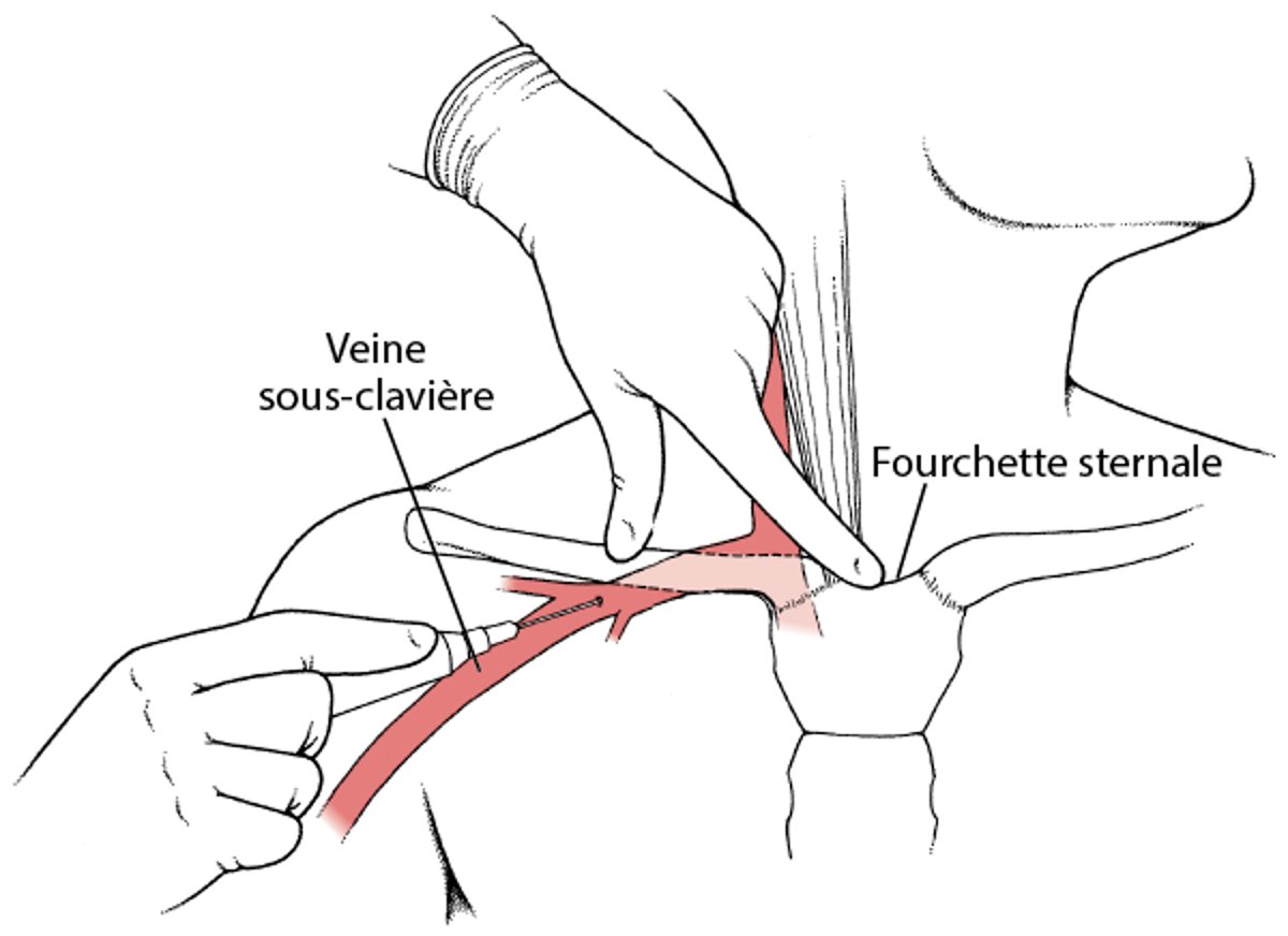 Cathéter dans une veine thoracique