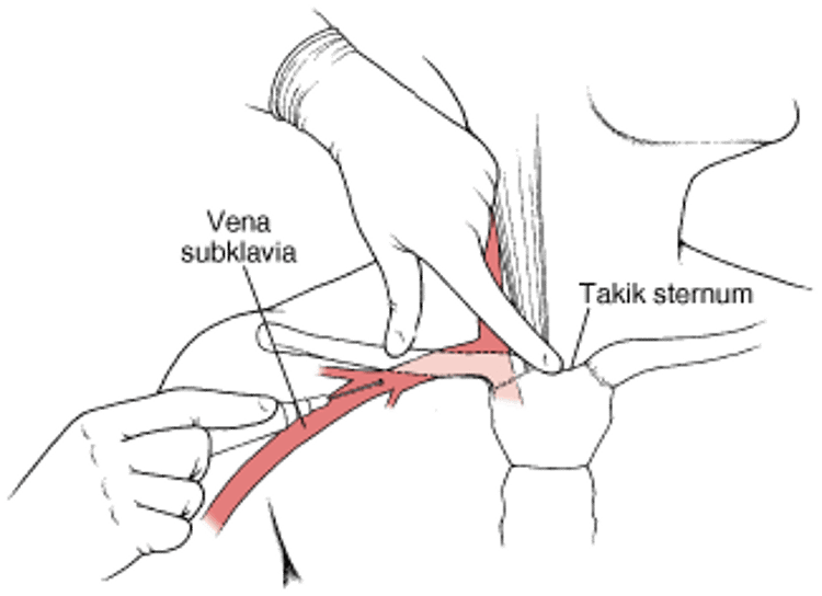 Kateter di dalam Vena Dada