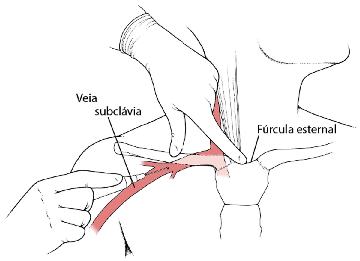 Cateter em uma veia do tórax