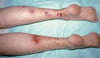 Cryoglobulinemia