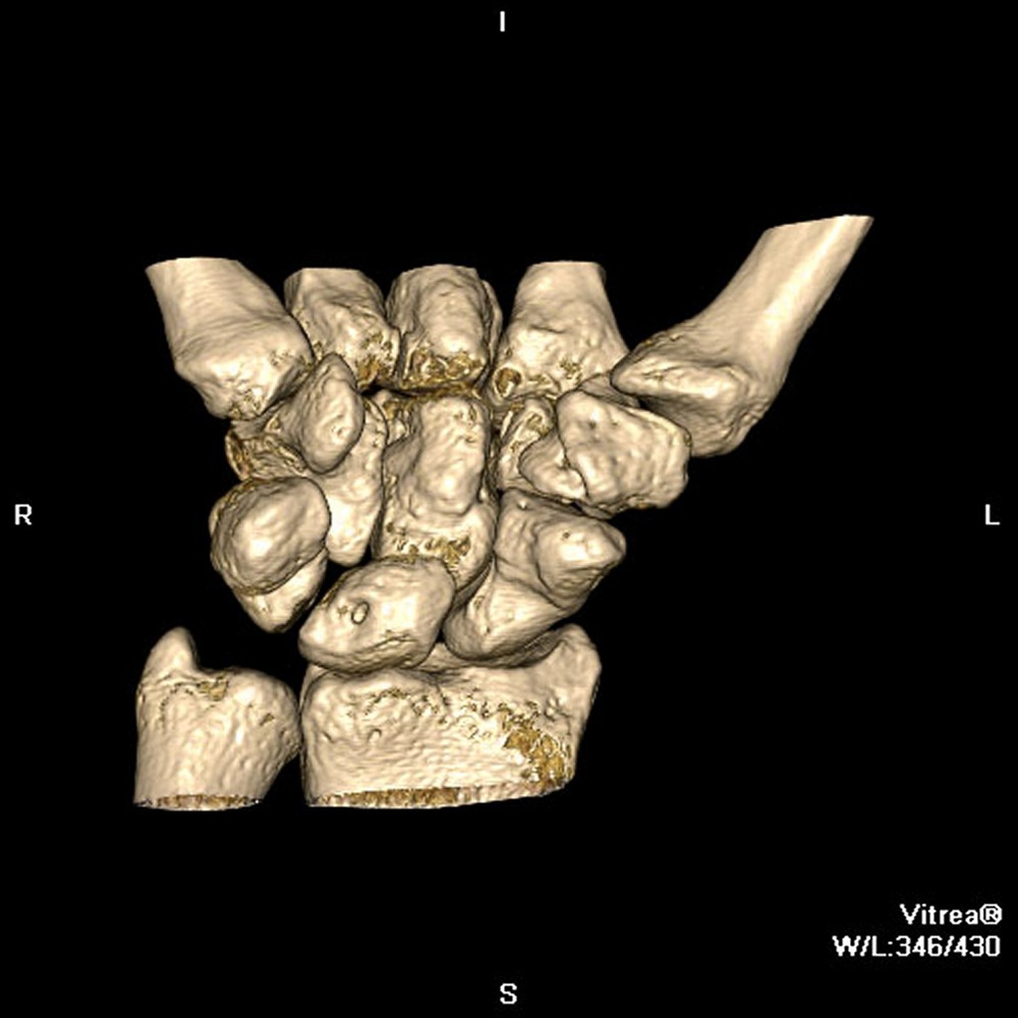 Computed Tomography (CT) of the Wrist (3-Dimensional Reconstruction)