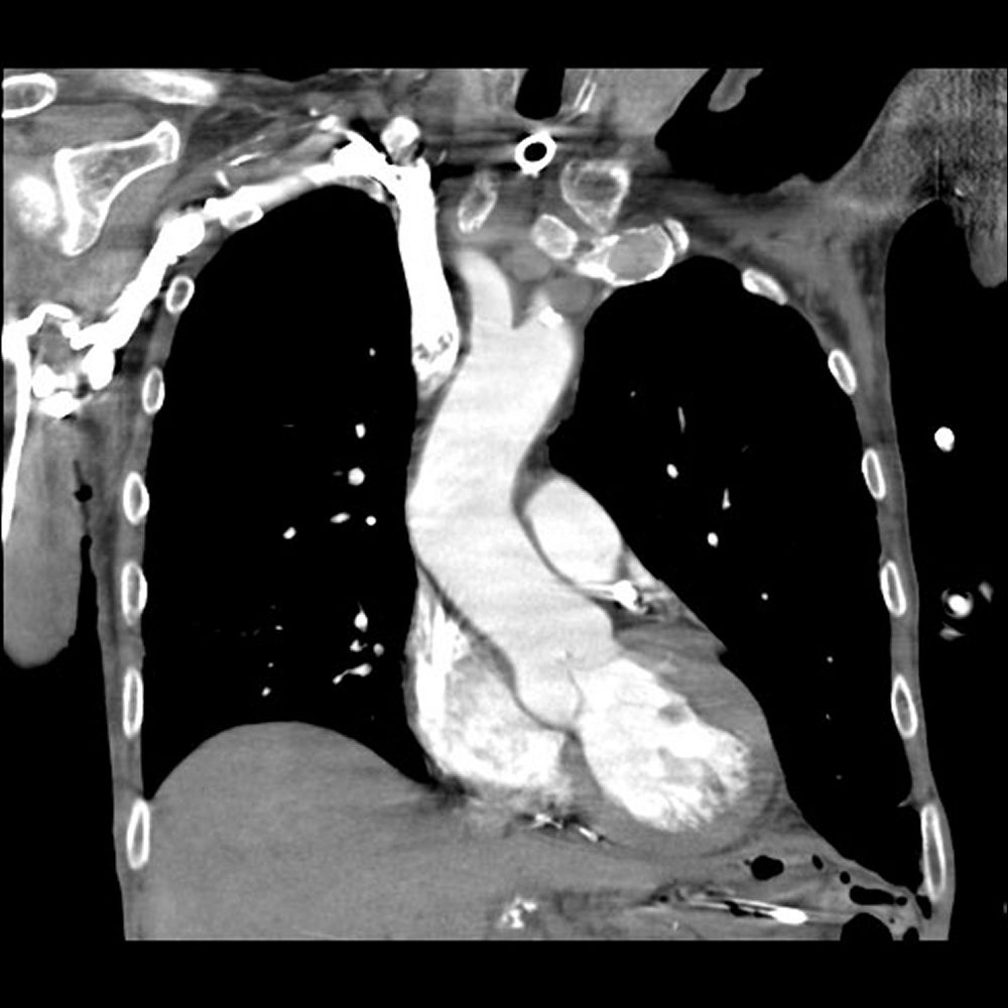 Angiografía pulmonar por TC