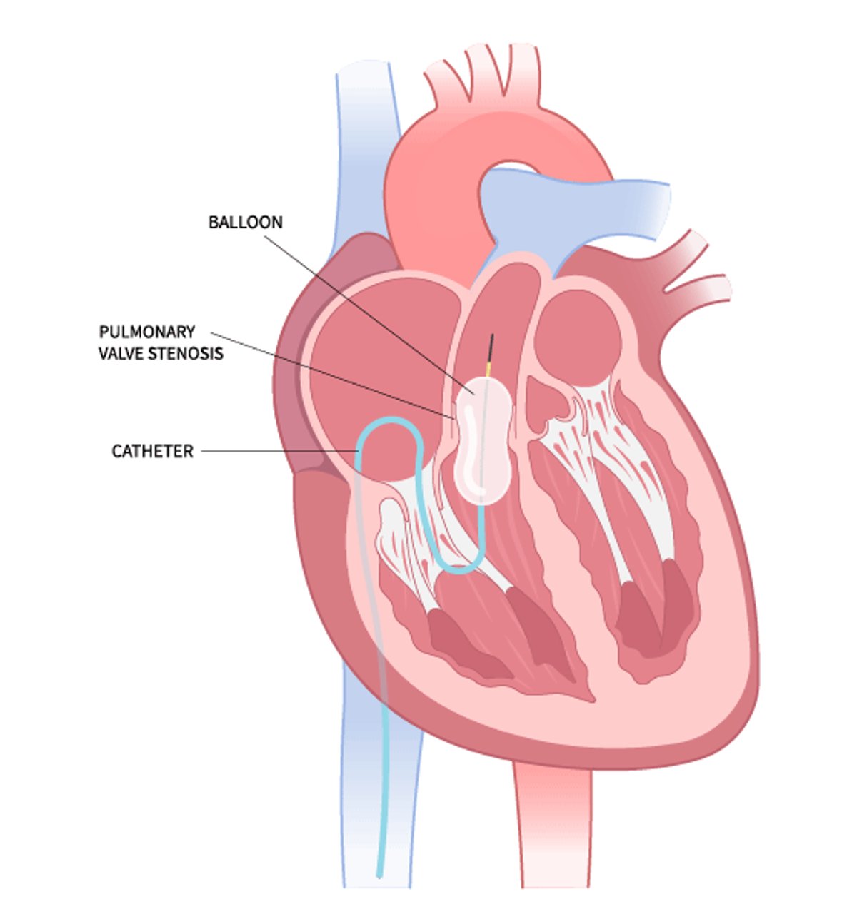 Balloon Valvuloplasty