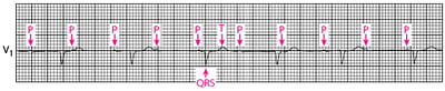 Third-degree Atrioventricular Block