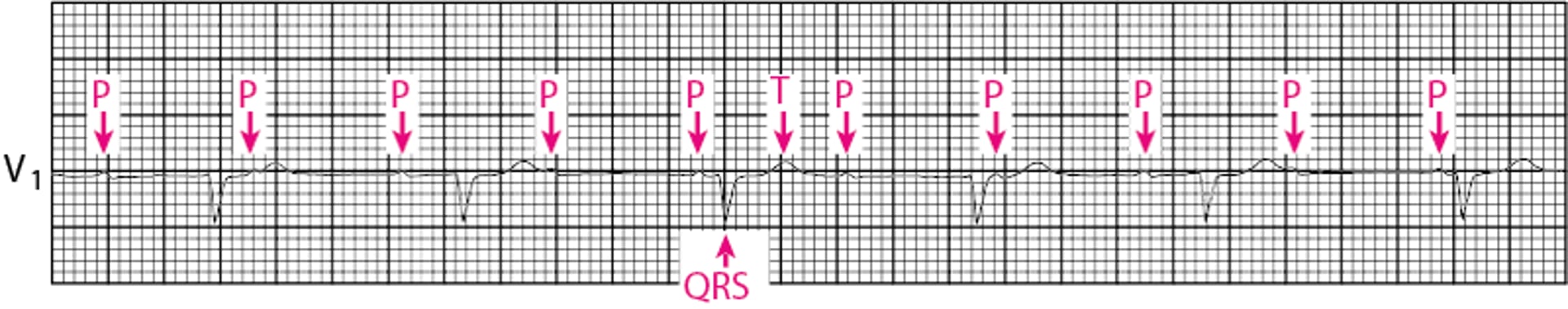 Bloqueo auriculoventricular de tercer grado