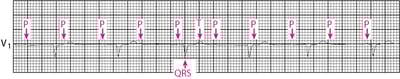 Bloqueo auriculoventricular de tercer grado