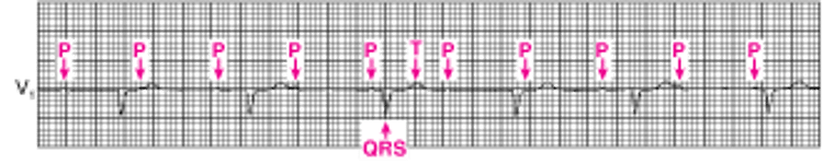 Penyumbatan Atrioventrikular Tingkat Tiga