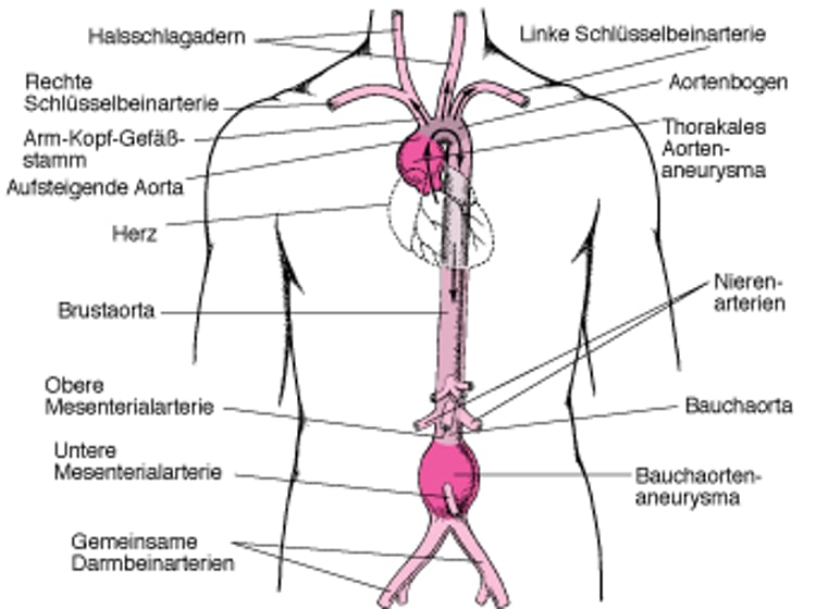 Wo Aortenaneurysmen auftreten