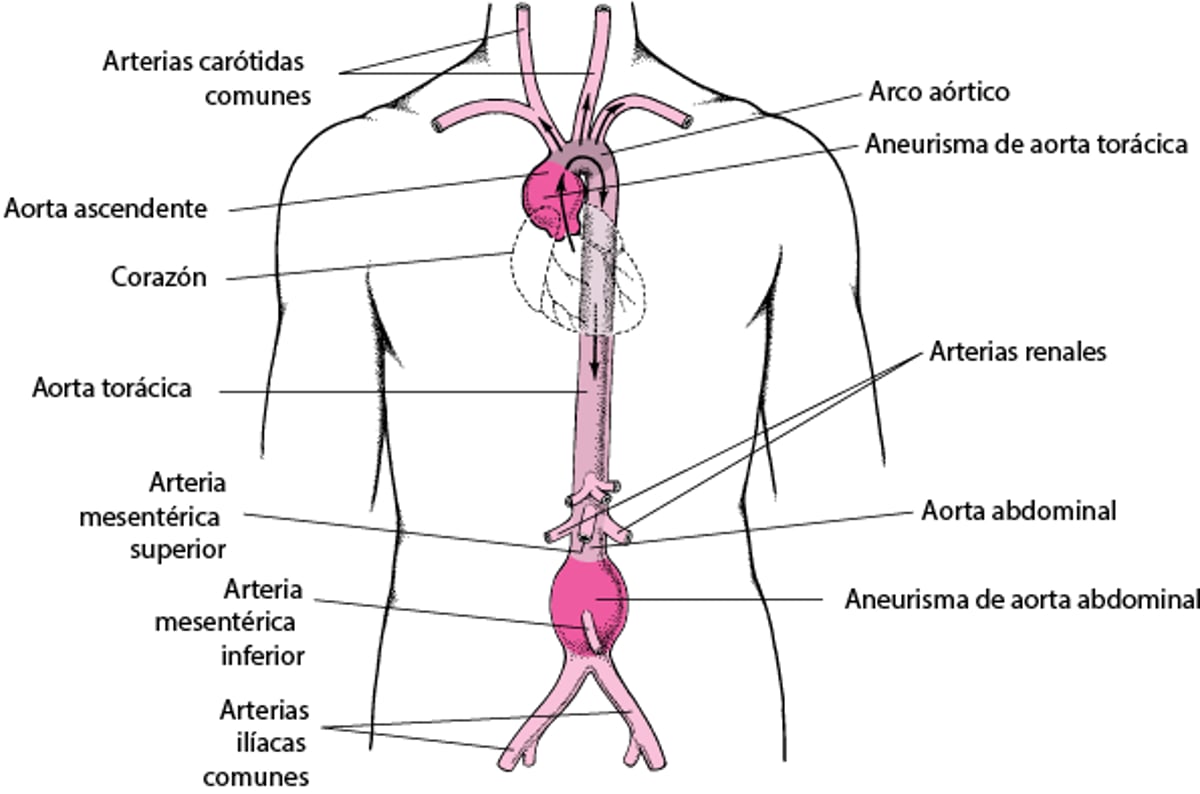 ¿Dónde se producen los aneurismas aórticos?