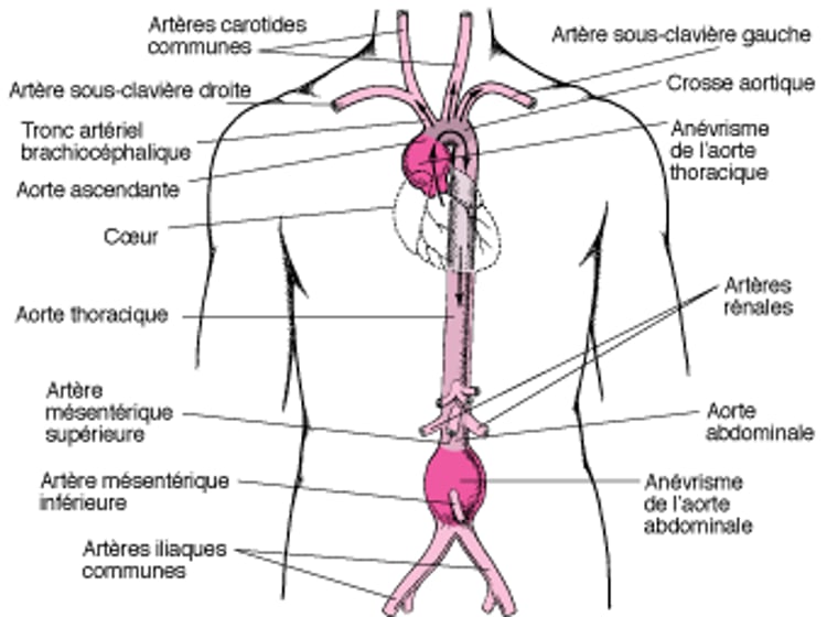 Où se produisent les anévrismes de l’aorte ?