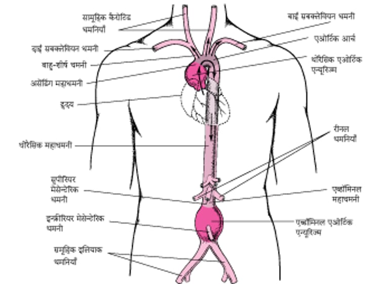अयोर्टिक एन्यूरिज्म कहाँ पर होती हैं?