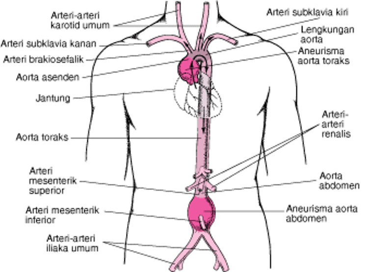 Di mana aorta aneurisma biasanya terjadi?