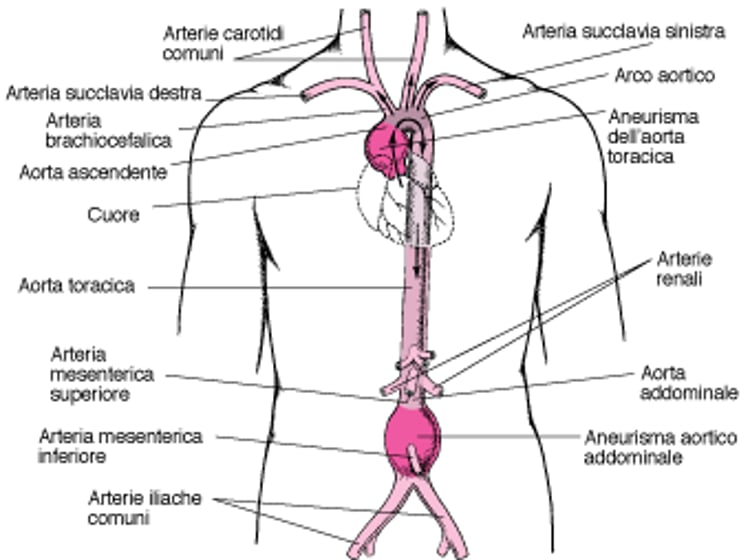 Dove si sviluppano gli aneurismi aortici?