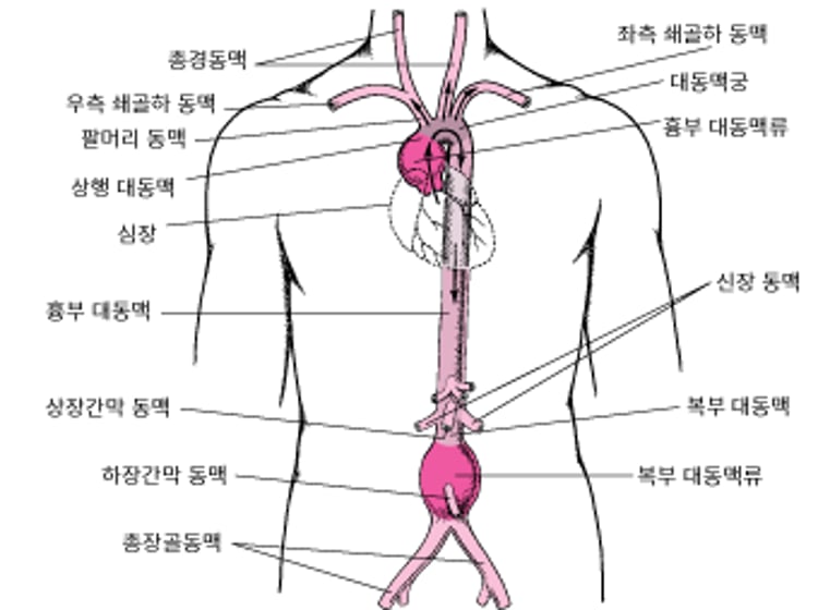 대동맥류는 어디에 생깁니까?