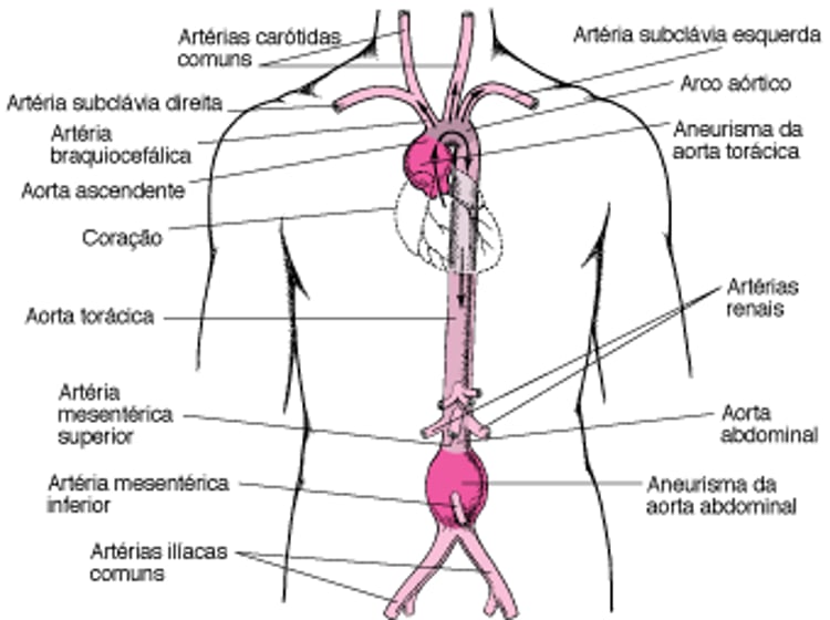 Onde ocorrem os aneurismas aórticos?