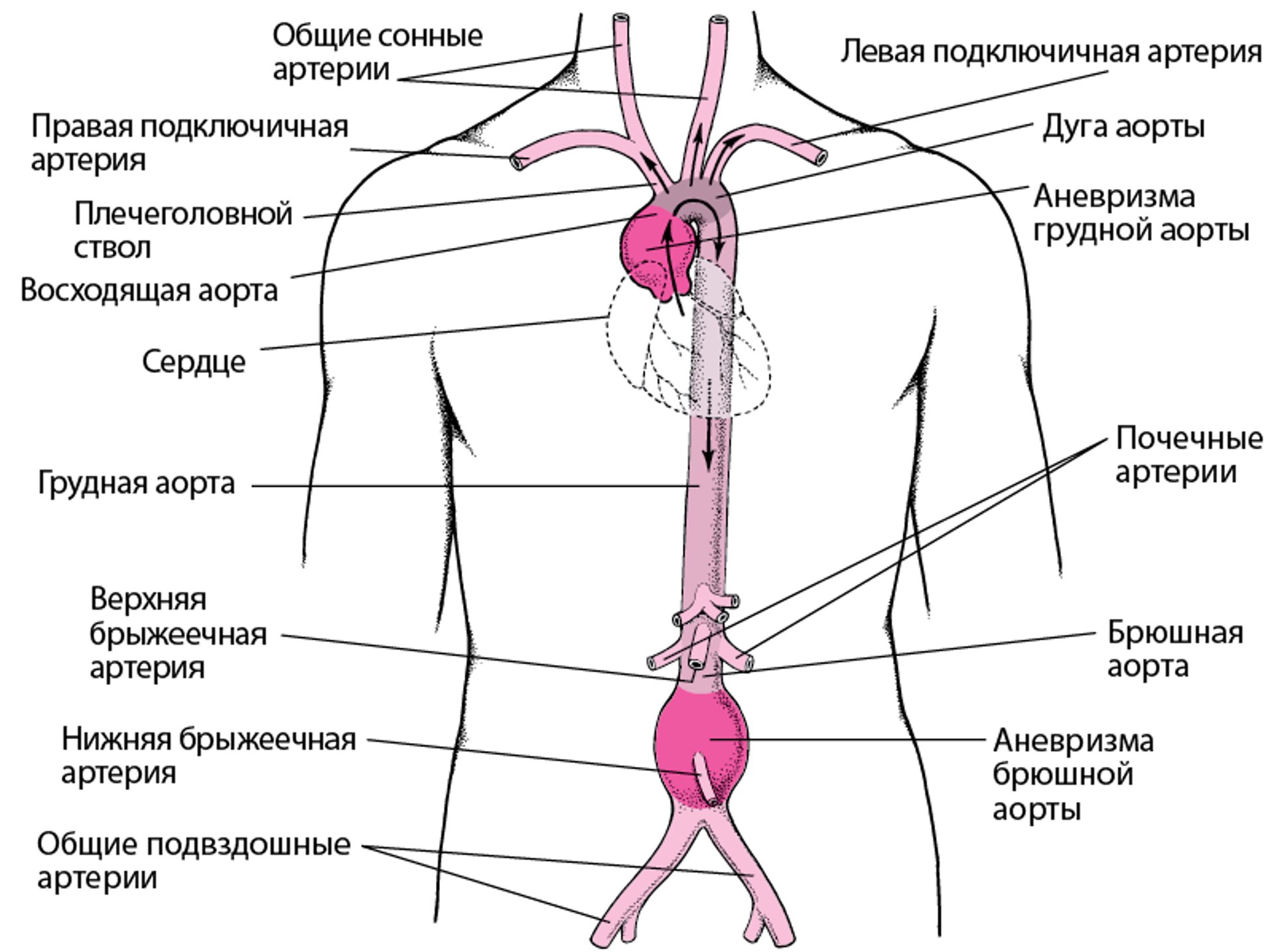 Где развиваются аневризмы аорты?