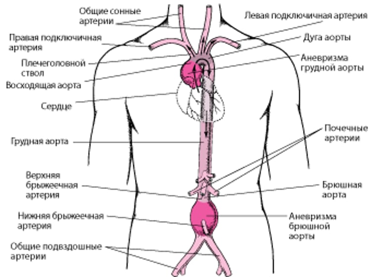 Где развиваются аневризмы аорты?