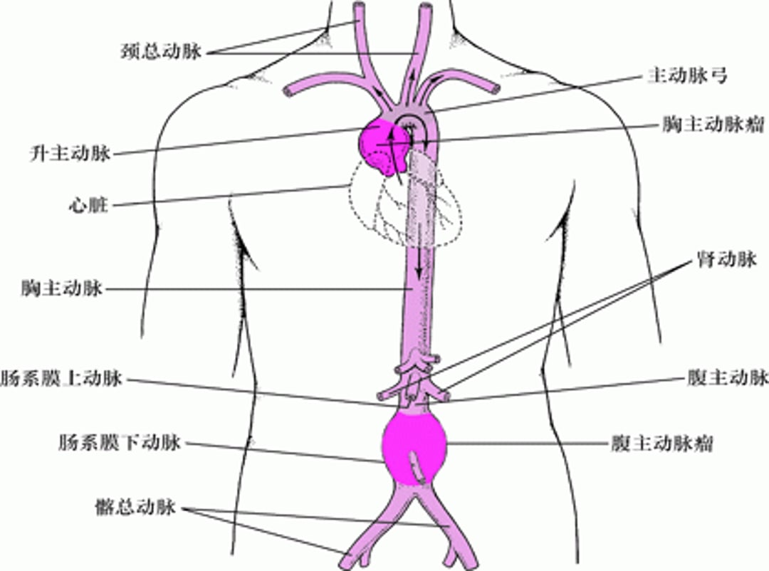主动脉瘤常出现在哪些部位？