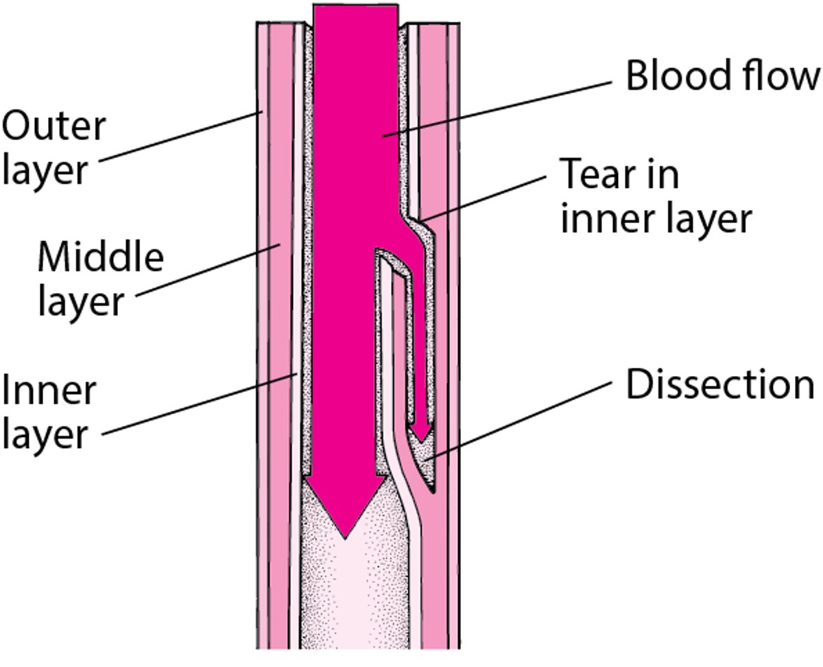 Understanding Aortic Dissection