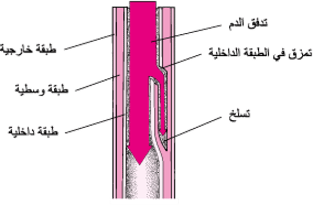 فهم تسلخ الأبهر