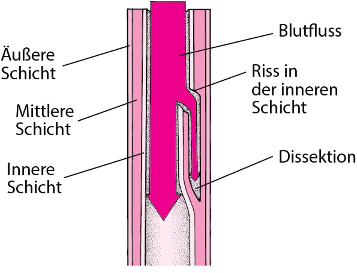 Veranschaulichung einer Aortendissektion
