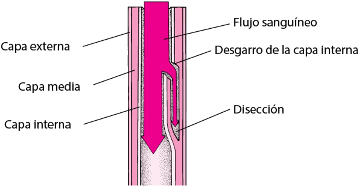 Qué es la disección aórtica