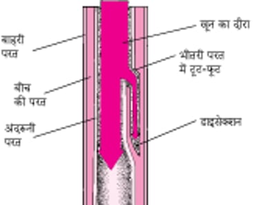 अयोर्टिक डाइसेक्शन को समझना