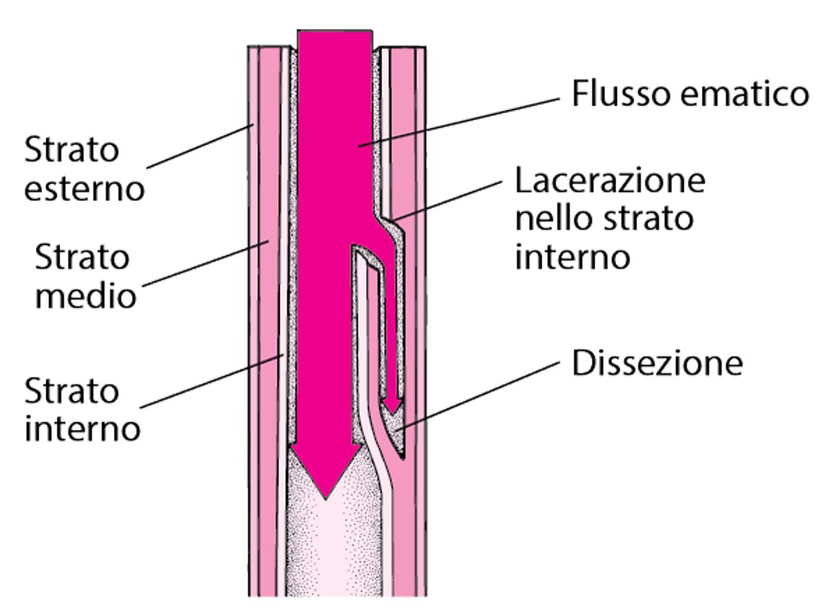 Cos’è la dissezione aortica?