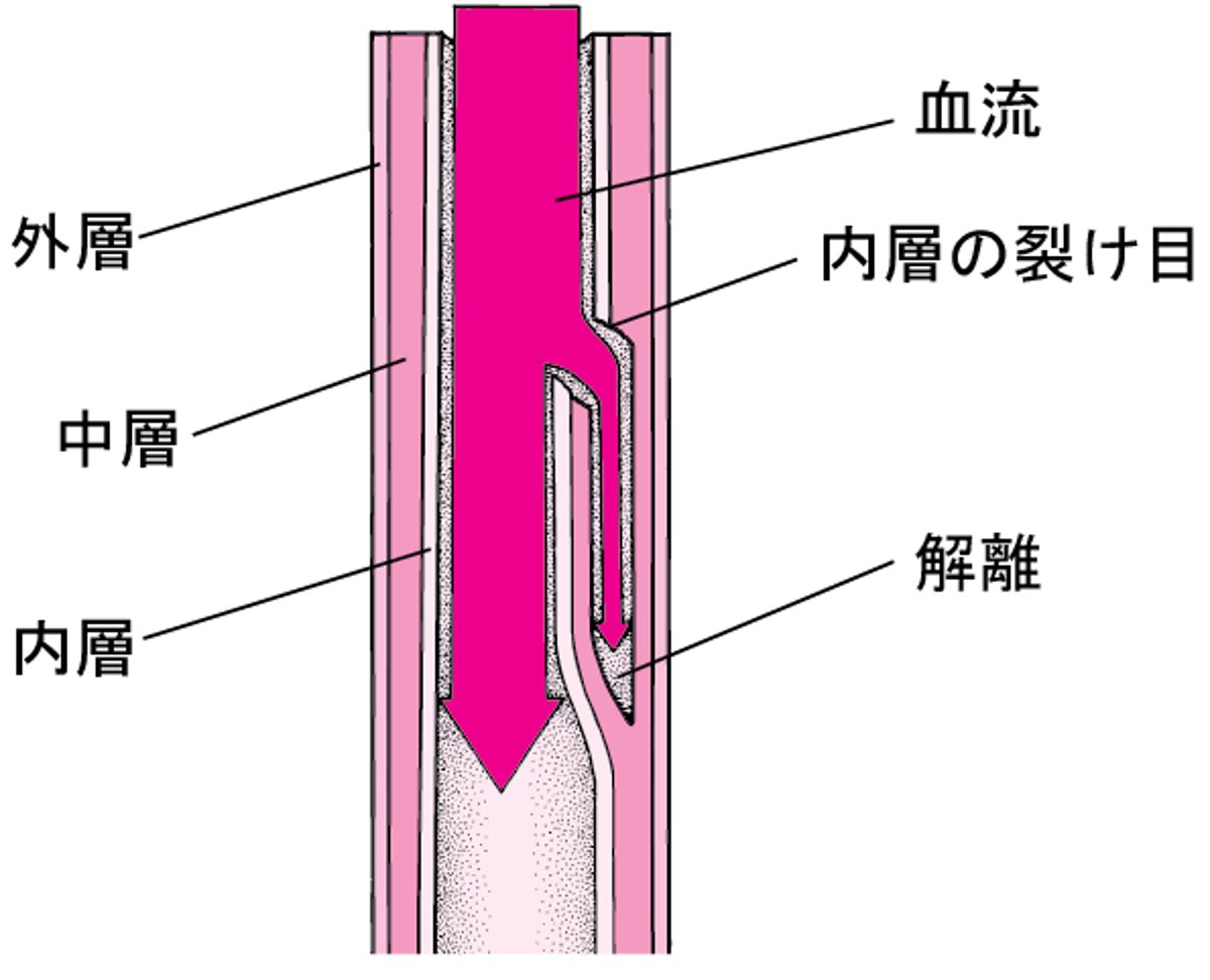 大動脈解離だいどうみゃくかいりについて