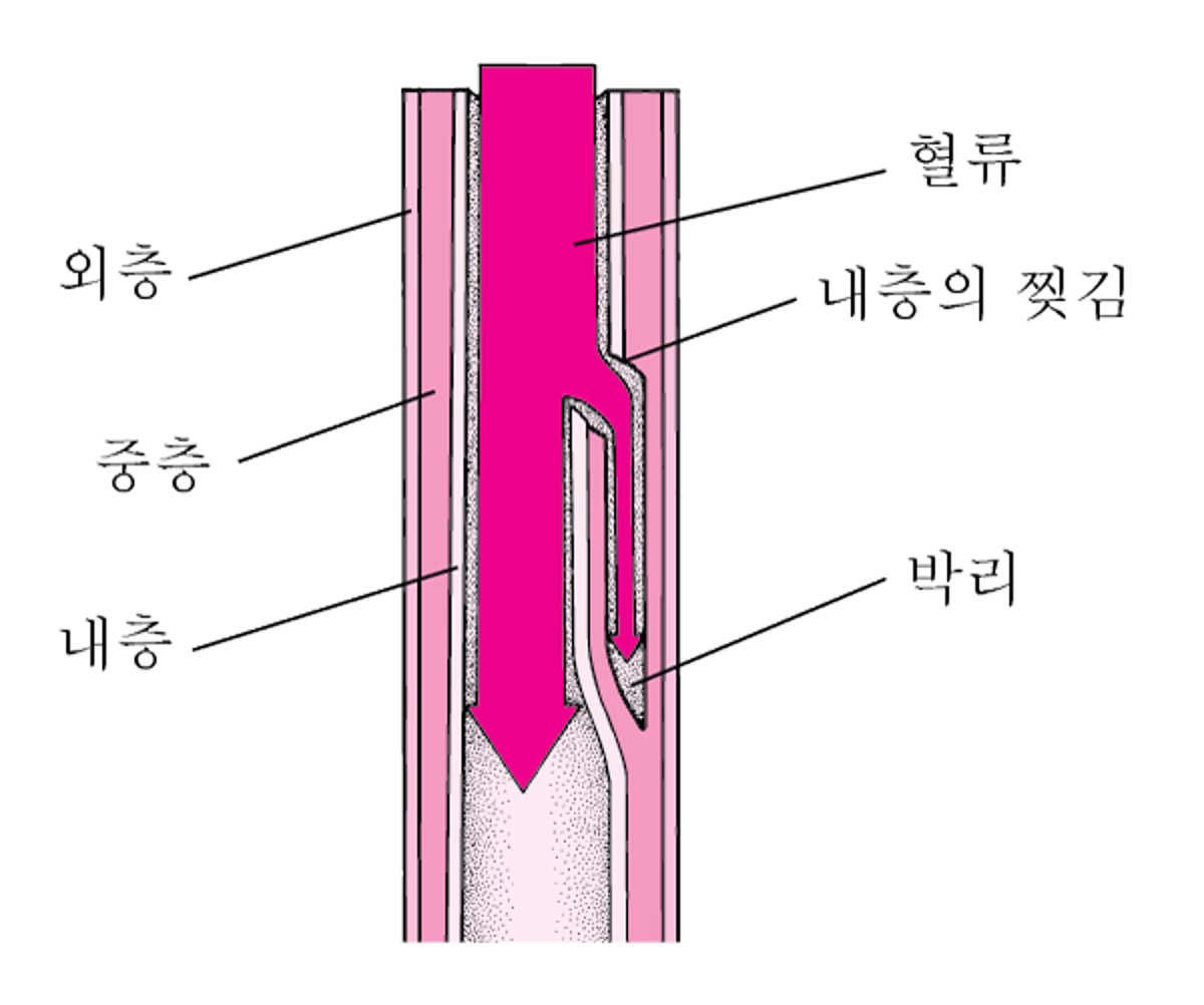 대동맥 박리란