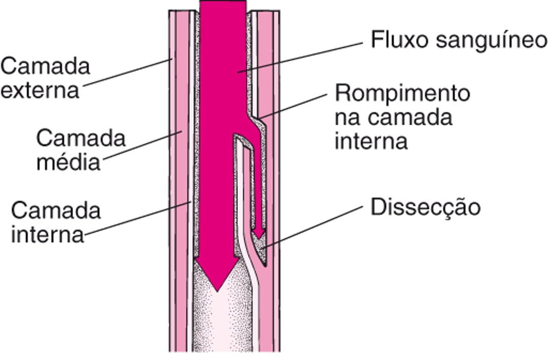 Entenda a dissecção aórtica