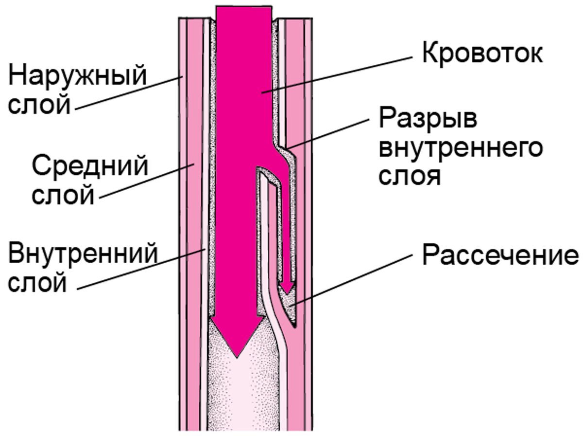 Объяснение расслоения аорты