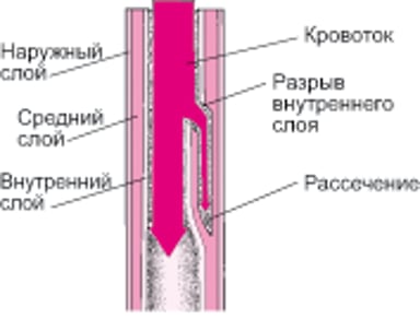 Объяснение расслоения аорты