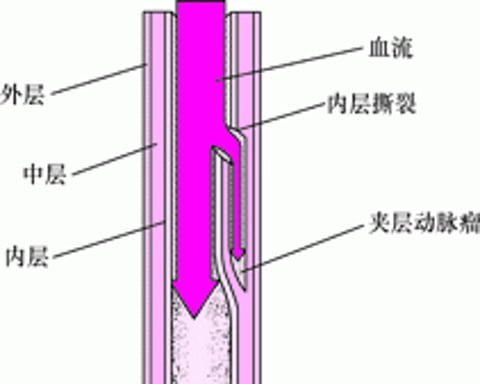 了解主动脉夹层