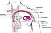 Keeping the Beat: Artificial Pacemakers