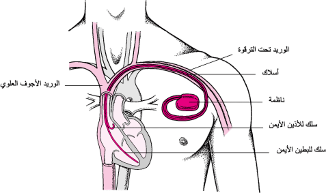 الحفاظ على ضربات القلب: الناظمات القلبية الاصطناعية