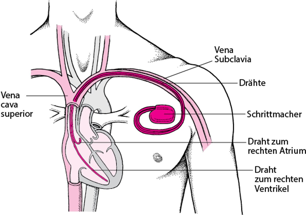 Stabilisierung des Herzschlags: Künstliche Schrittmacher
