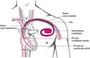Garder le rythme : Stimulateurs cardiaques artificiels