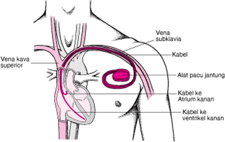 Menjaga Detak Jantung: Alat Pacu Jantung Buatan