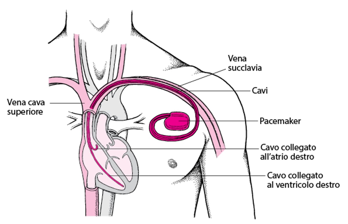 Mantenimento del battito: pacemaker artificiali
