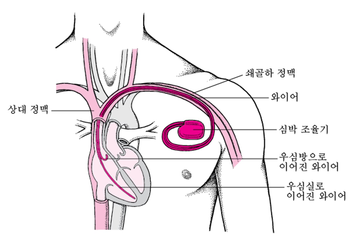 박동 유지: 인공 박동조율기