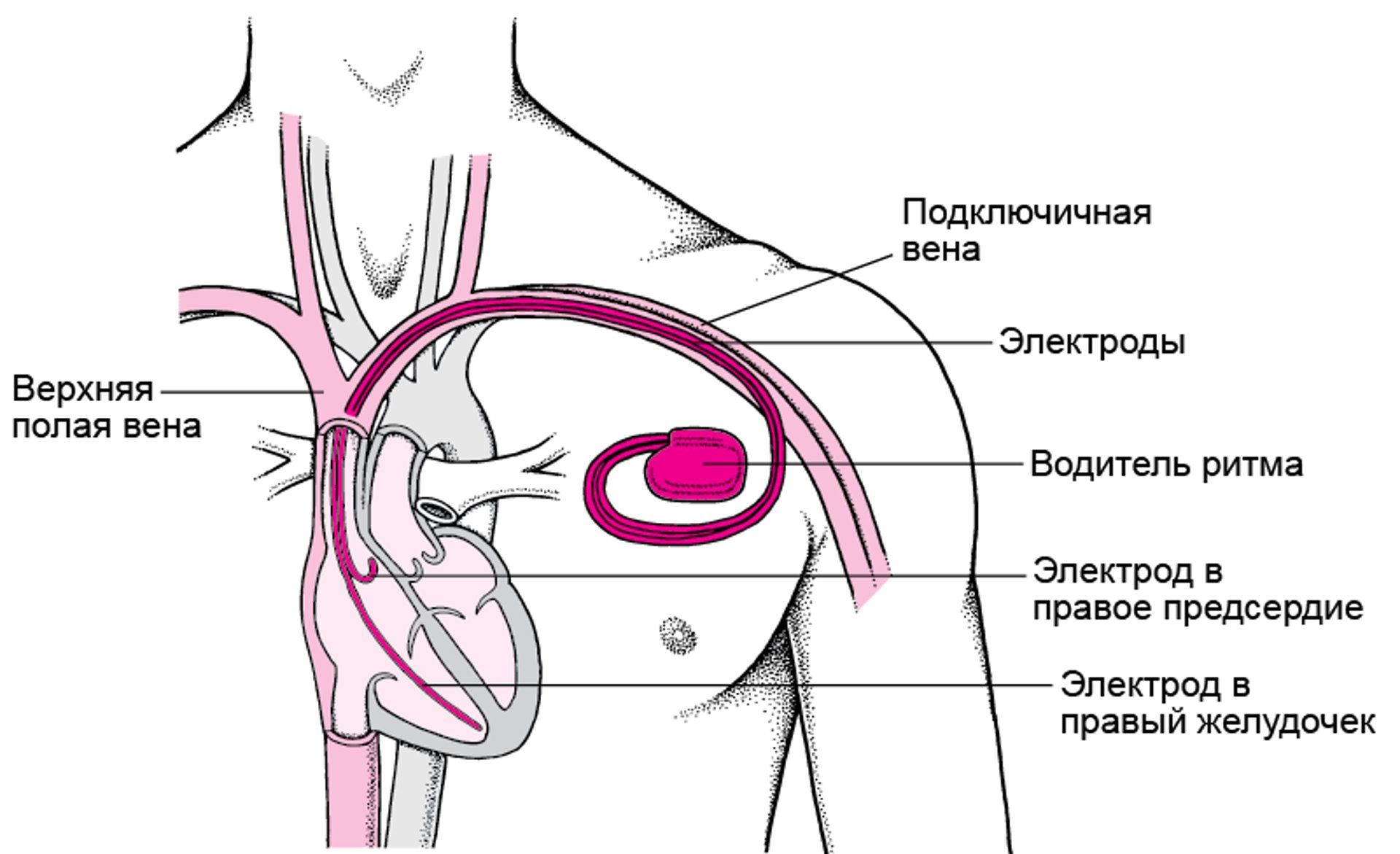 Поддержание сердечного ритма Электрокардиостимуляторы