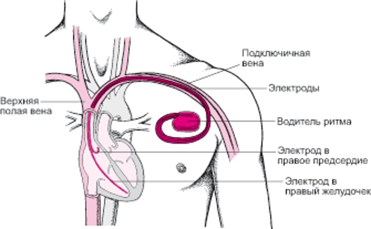 Поддержание сердечного ритма Электрокардиостимуляторы