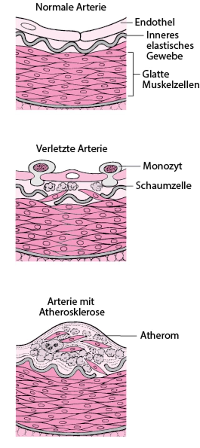 Wie Atherosklerose entsteht