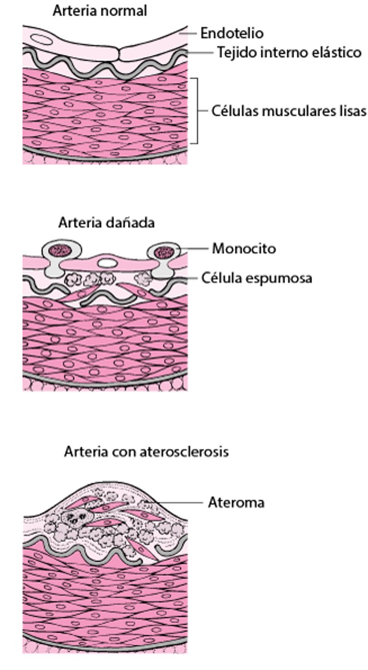 Cómo se desarrolla la ateroesclerosis