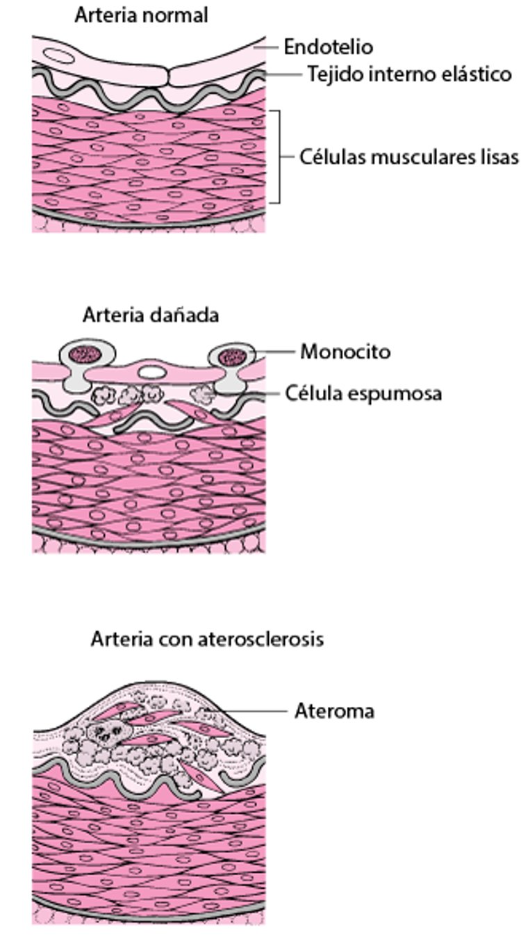 Cómo se desarrolla la ateroesclerosis