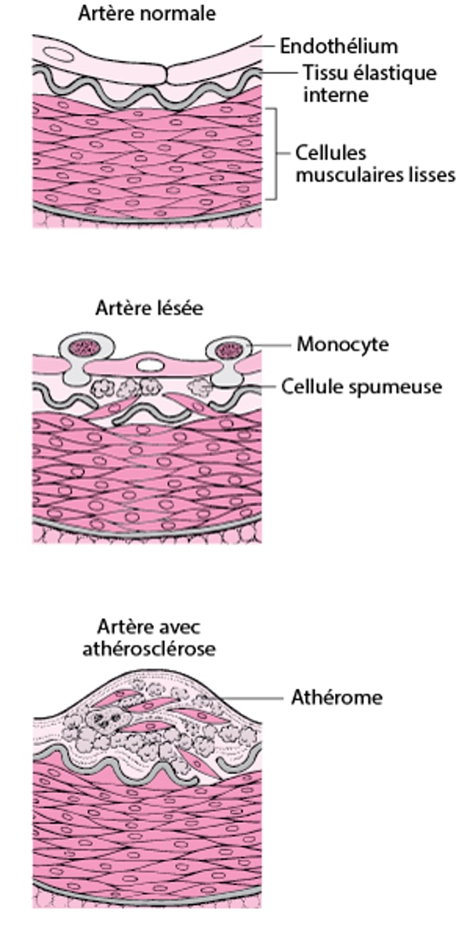 Comment l’athérosclérose se produit